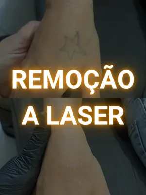 Capa_Remoção