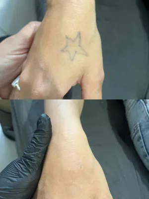 Remoção 3