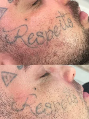 Remoção 4